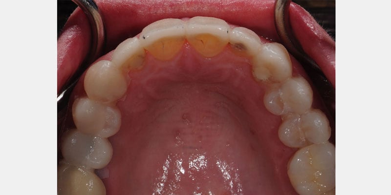 Carillas dentales: las señales de una filtración que conviene detectar a tiempo